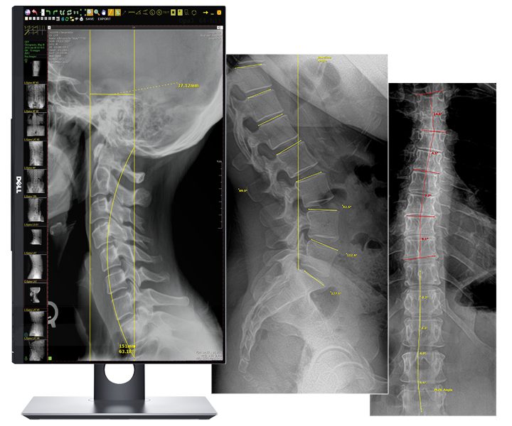 Digital X-ray analysis: a monitor displaying a cervical X-ray with measurement lines, beside lumbar and full-spine films marked with angles